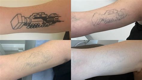 does laser tattoo removal work